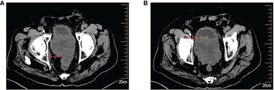 Malignant glomus tumor of prostate: A case report